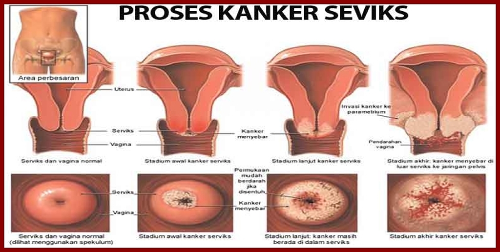 Gambar Kanker Serviks Pada Wanita - KibrisPDR