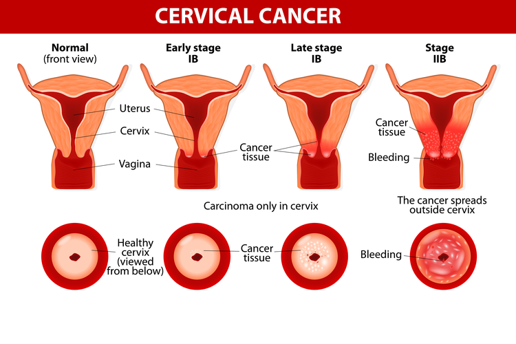 Detail Gambar Kanker Serviks Pada Wanita Nomer 3