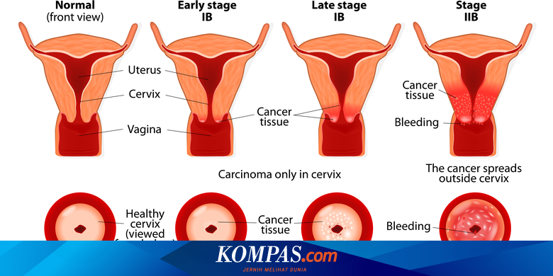 Detail Gambar Kanker Serviks Pada Wanita Nomer 25
