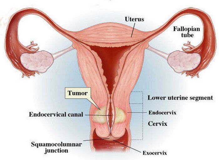Detail Gambar Kanker Serviks Pada Wanita Nomer 48