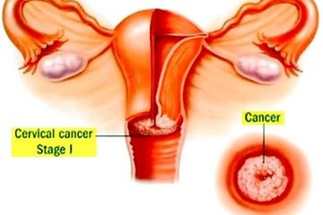 Detail Gambar Kanker Serviks Pada Wanita Nomer 7