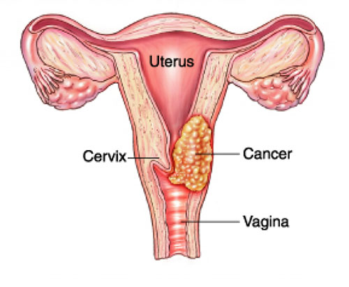 Detail Gambar Kanker Serviks Pada Wanita Nomer 8