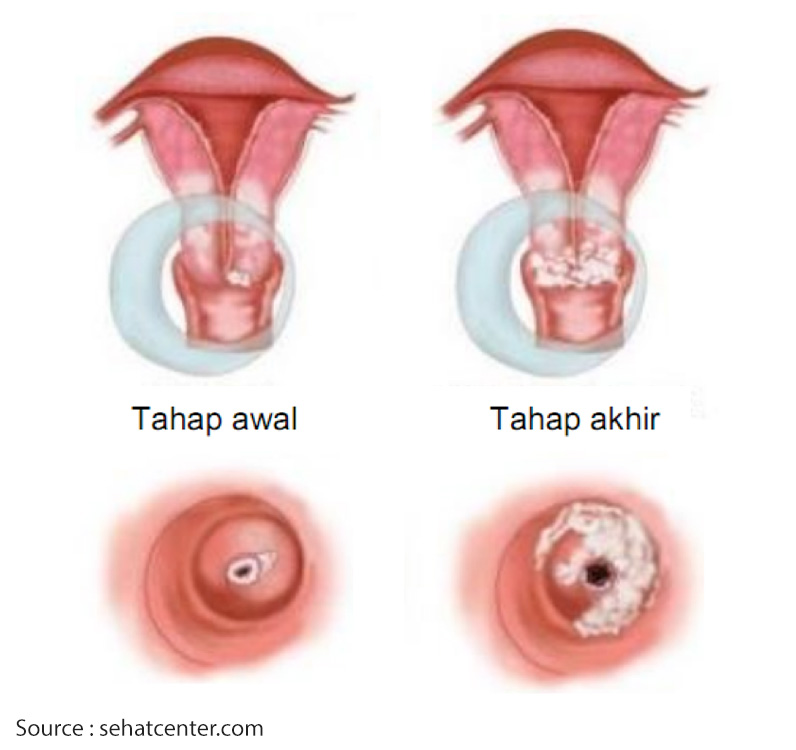 Detail Gambar Kanker Serviks Pada Wanita Nomer 10