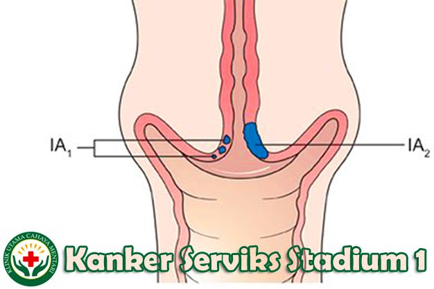 Detail Gambar Kanker Serviks Stadium 2 Nomer 27