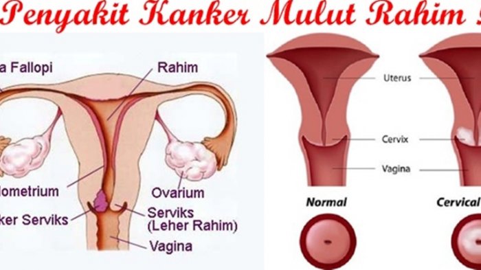Detail Gambar Kanker Serviks Stadium 2 Nomer 53