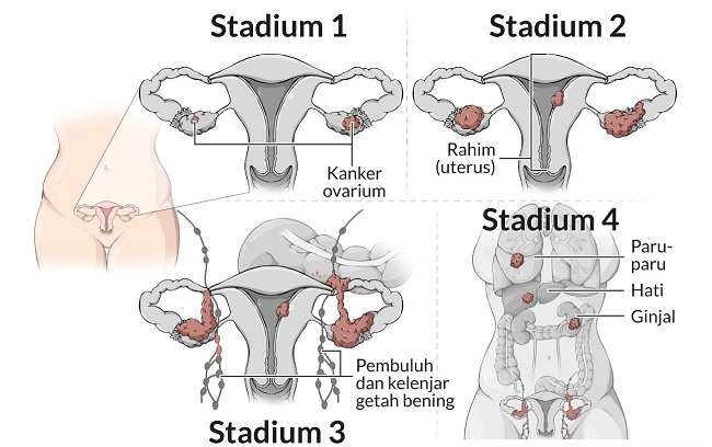 Detail Gambar Kanker Serviks Stadium 2 Nomer 9