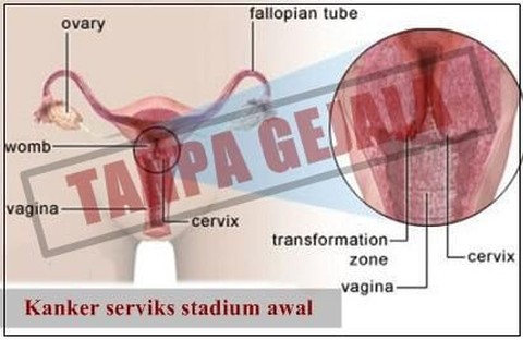 Detail Gambar Kanker Serviks Stadium 3 Nomer 24