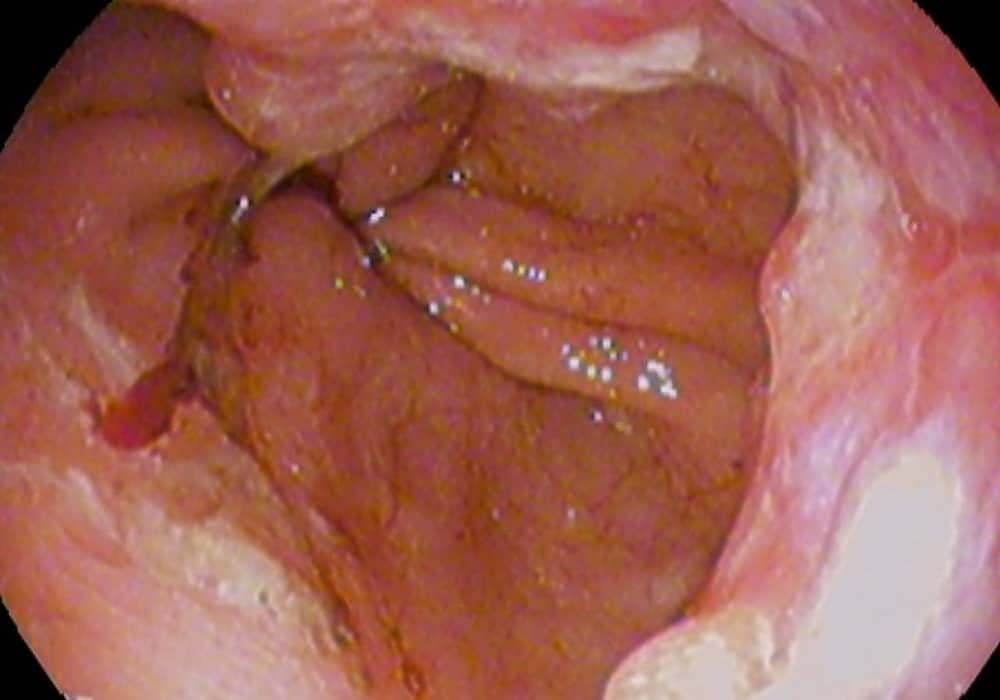 Detail Gambar Kanker Tenggorokan Nomer 31