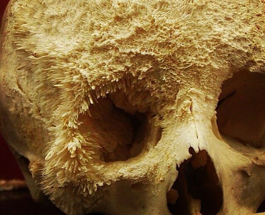 Detail Gambar Kanker Tulang Nomer 49