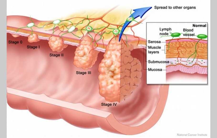 Detail Gambar Kanker Usus Nomer 9