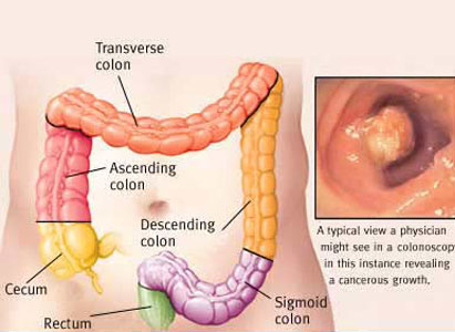 Detail Gambar Kanker Usus Nomer 34