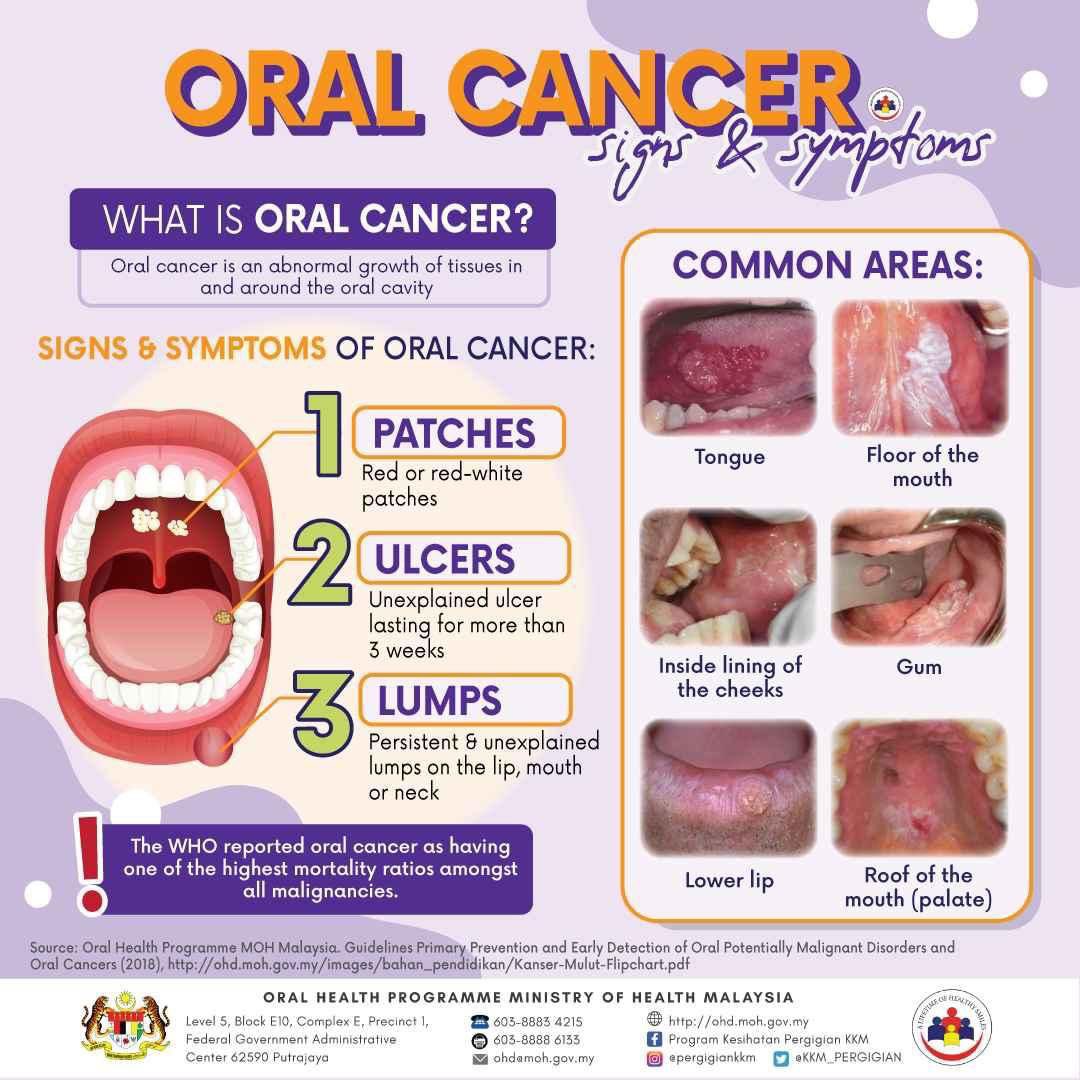 Detail Gambar Kanser Mulut Nomer 4