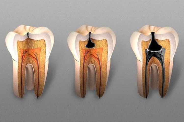Detail Gambar Karies Gigi Nomer 13