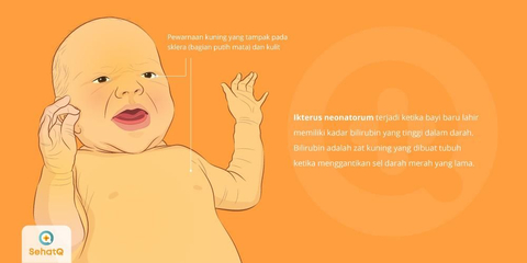 Detail Contoh Mata Bayi Kuning Nomer 42