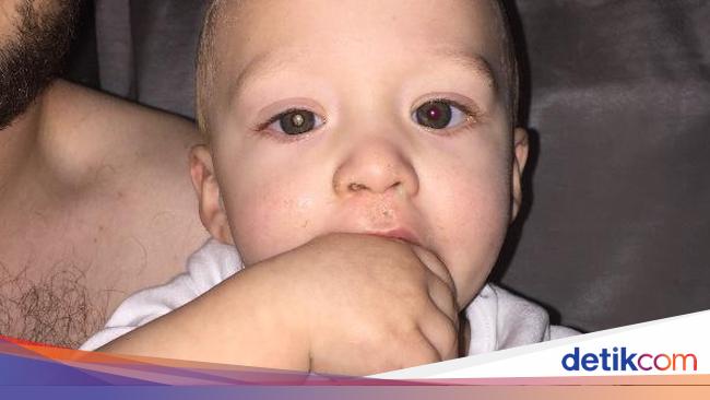 Detail Contoh Mata Bayi Kuning Nomer 44