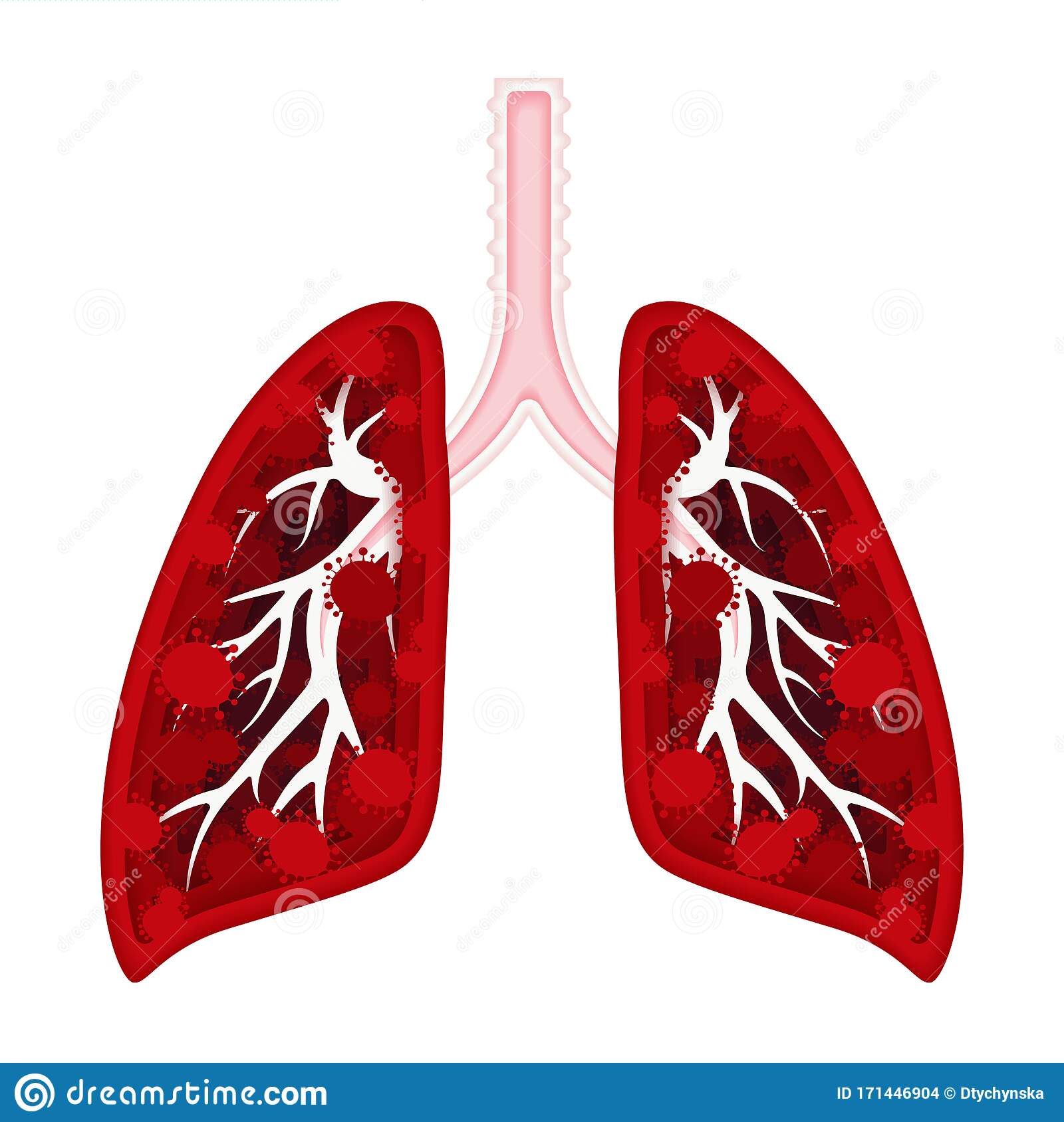 Detail Gambar Kartun Tuberculosis Nomer 26