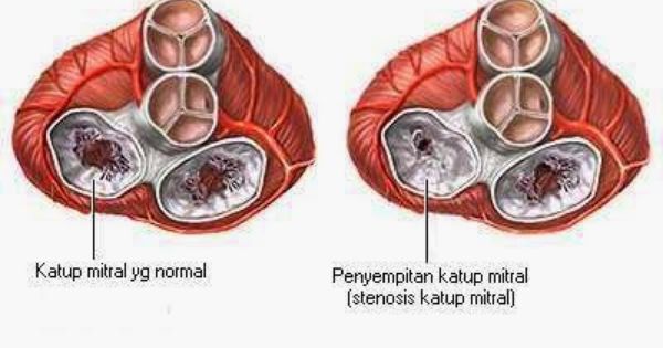 Detail Gambar Katup Jantung Nomer 16