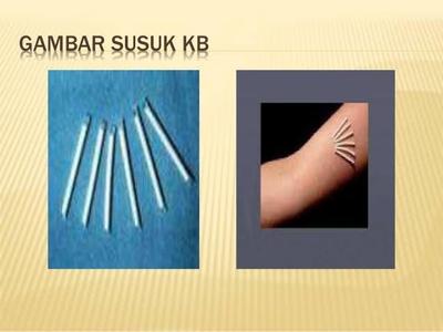 Detail Gambar Kb Implant Nomer 28