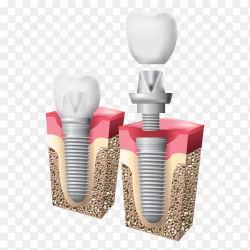 Detail Gambar Kb Implant Png Nomer 14