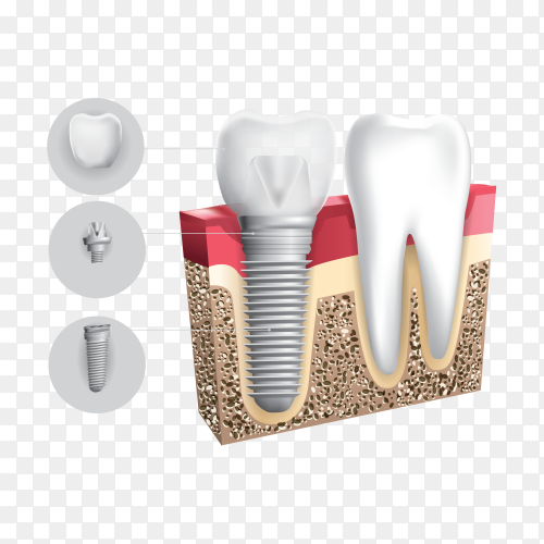 Detail Gambar Kb Implant Png Nomer 18