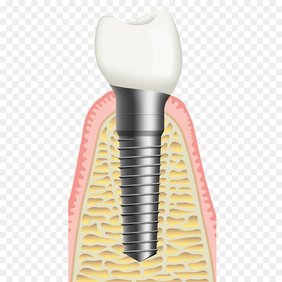 Detail Gambar Kb Implant Png Nomer 20