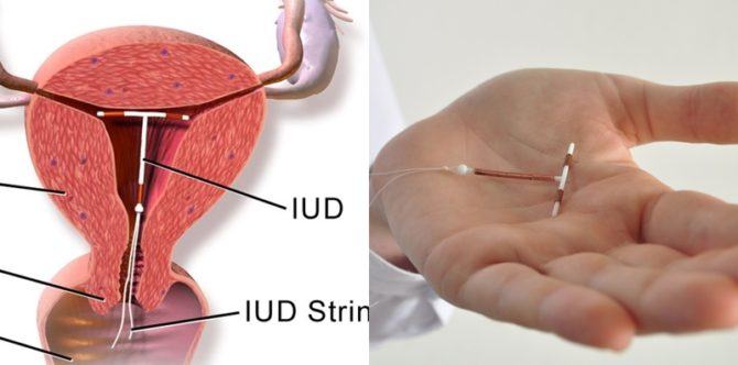 Gambar Kb Iud - KibrisPDR