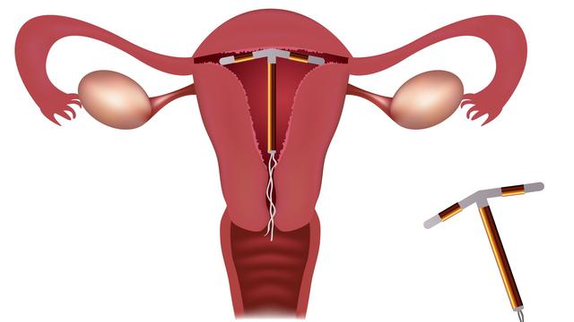 Detail Gambar Kb Iud Nomer 15