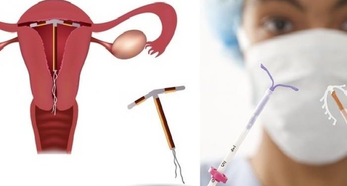 Detail Gambar Kb Iud Nomer 32