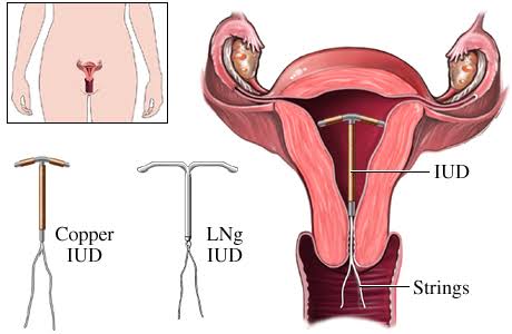 Detail Gambar Kb Iud Nomer 42