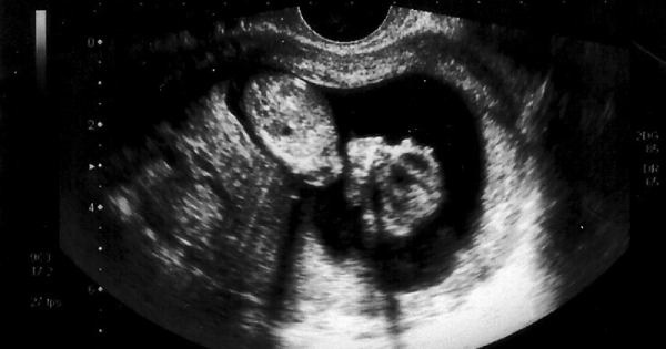 Detail Gambar Kehamilan 2 Bulan Nomer 12