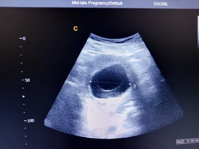 Detail Gambar Kehamilan 2 Bulan Nomer 34