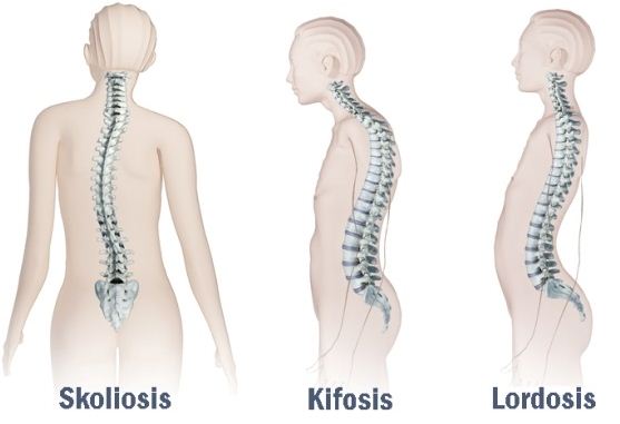 Detail Gambar Kelainan Lordosis Nomer 14