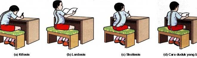 Detail Gambar Kelainan Lordosis Nomer 22