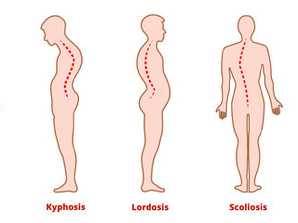 Detail Gambar Kelainan Lordosis Nomer 4