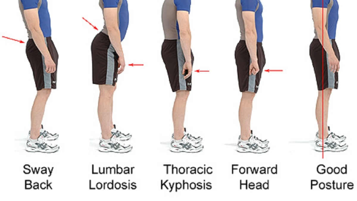 Detail Gambar Kelainan Lordosis Nomer 6