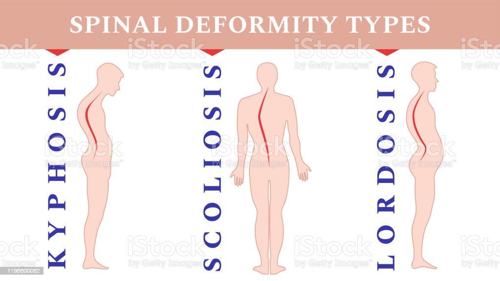 Detail Gambar Kelainan Lordosis Nomer 51