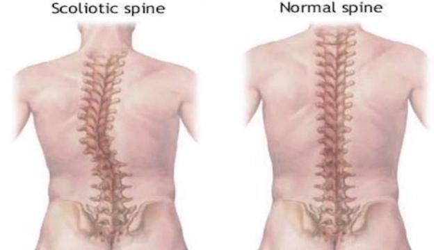 Detail Gambar Kelainan Lordosis Nomer 52