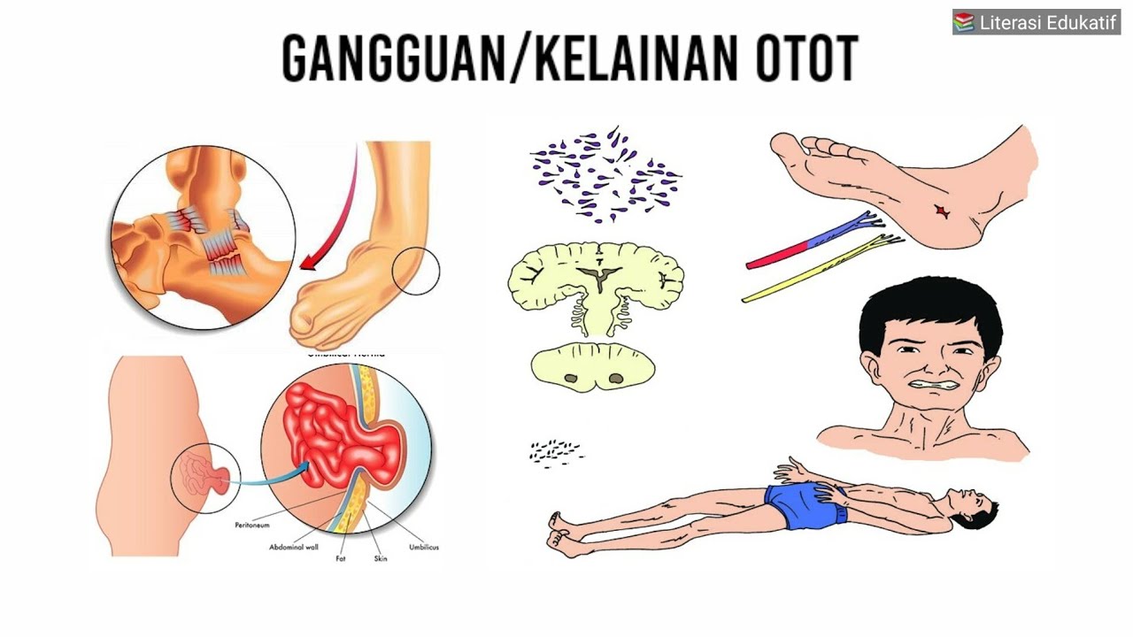 Detail Gambar Kelainan Otot Nomer 13