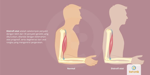 Detail Gambar Kelainan Otot Nomer 53