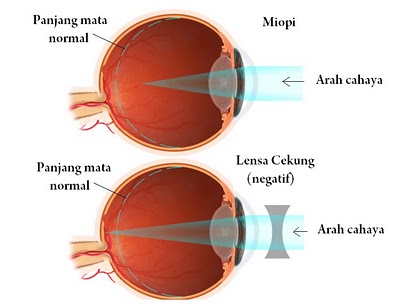 Detail Gambar Kelainan Pada Mata Nomer 13