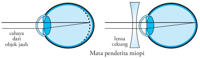 Detail Gambar Kelainan Pada Mata Nomer 32