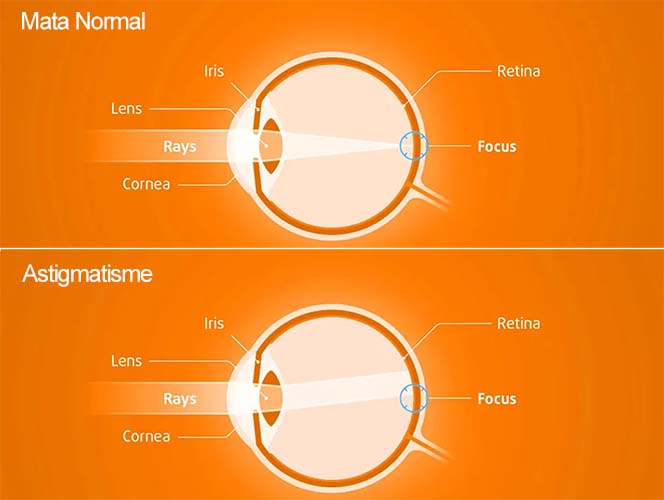 Detail Gambar Kelainan Pada Mata Nomer 42