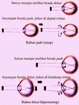 Detail Gambar Kelainan Pada Mata Nomer 5