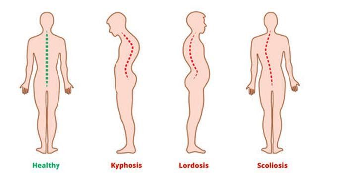 Detail Gambar Kelainan Skoliosis Nomer 32