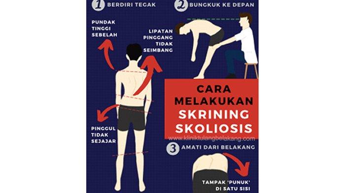 Detail Gambar Kelainan Skoliosis Nomer 36