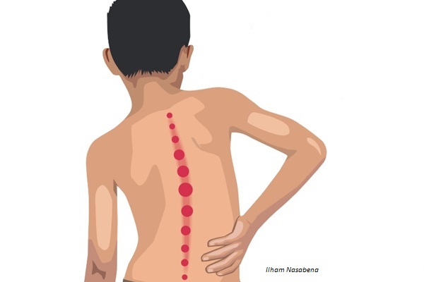 Detail Gambar Kelainan Skoliosis Nomer 9