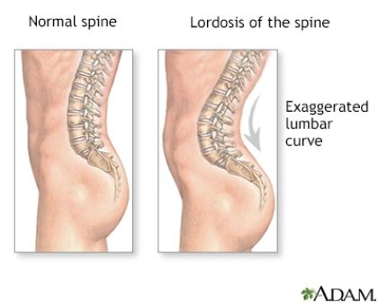 Detail Gambar Kelainan Tulang Lordosis Nomer 25