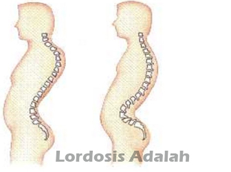 Detail Gambar Kelainan Tulang Lordosis Nomer 26