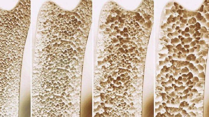 Detail Gambar Kelainan Tulang Osteoporosis Nomer 12