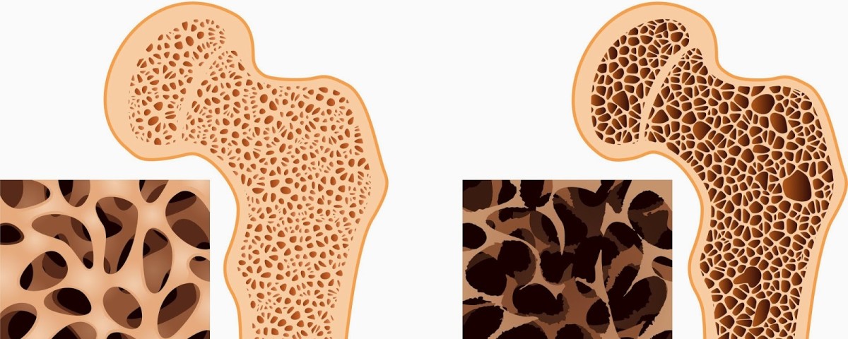 Detail Gambar Kelainan Tulang Osteoporosis Nomer 13